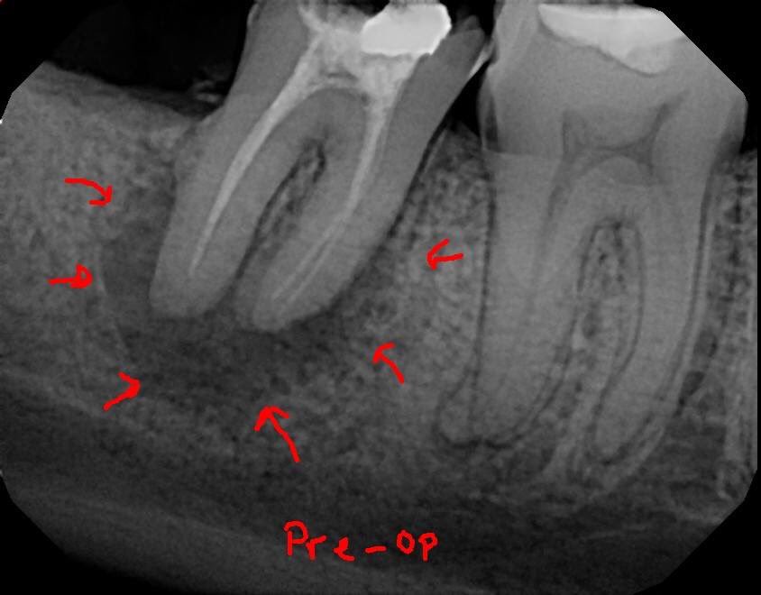 DrRicoShort's tweet photo. The SHORT Case Of The Day!
Tooth #31 ~ Relax or Extract?
It had a previous root canal from India over 5 years ago with a large PAP. I performed a retreatment in 2 visits. Patient returned for a 5 year recall still asymptomatic and very nice bone healing.
#RelaxDontExtract
#Roots https://t.co/CN30SnENwN