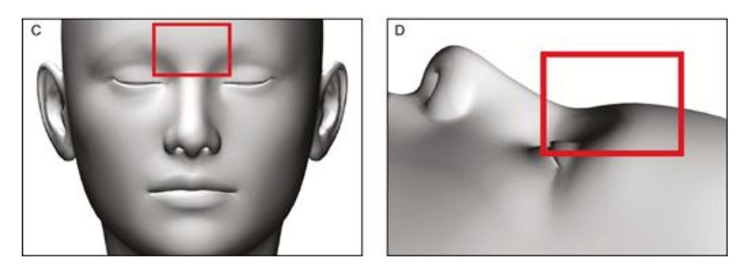 Aesthetic Surgery Journal/ASJ Open Forum (@asjrnl) on Twitter photo From Facial Section Editor Dr. Jim Zins, a #FreeRead: Pathophysiology Study of Filler-Induced Blindness goo.gl/icpY38 + a Commentary by Dr. Jean Carruthers: goo.gl/8XujZ6 <a href="/NahaiDr/">Dr Nahai</a> <a href="/DrChrisSurek/">Dr. Chris Surek</a> <a href="/sammysinnoMD/">Sammy Sinno</a> <a href="/drkenkel/">Jeffrey Kenkel, MD</a> <a href="/drroykim/">Roy Kim πΊπΈ</a> <a href="/AChandMD/">Akash Chandawarkar</a> @ASAPS From Facial Section Editor Dr. Jim Zins, a #FreeRead: Pathophysiology Study of Filler-Induced Blindness goo.gl/icpY38 + a Commentary by Dr. Jean Carruthers: goo.gl/8XujZ6 <a href="/NahaiDr/">Dr Nahai</a> <a href="/DrChrisSurek/">Dr. Chris Surek</a> <a href="/sammysinnoMD/">Sammy Sinno</a> <a href="/drkenkel/">Jeffrey Kenkel, MD</a> <a href="/drroykim/">Roy Kim πΊπΈ</a> <a href="/AChandMD/">Akash Chandawarkar</a> @ASAPS