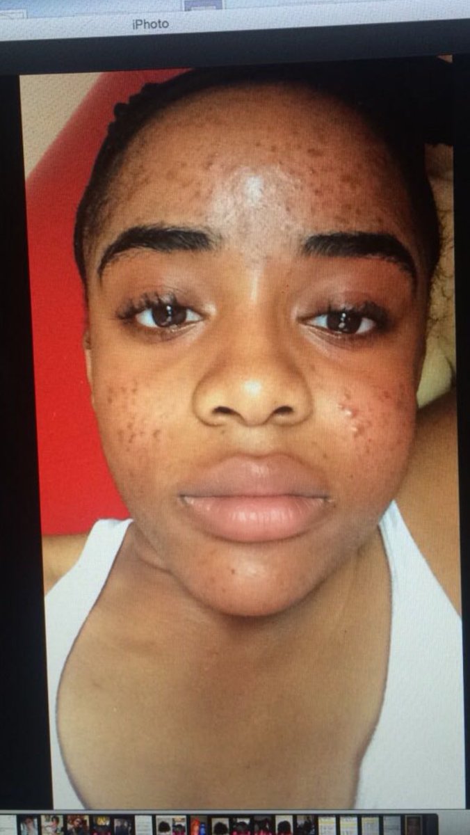 dolitashaw's tweet image. my skin transformation is defo one for the memories🤧