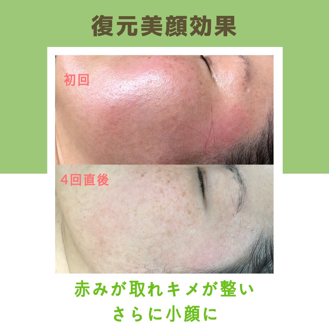 ピーリングエステ