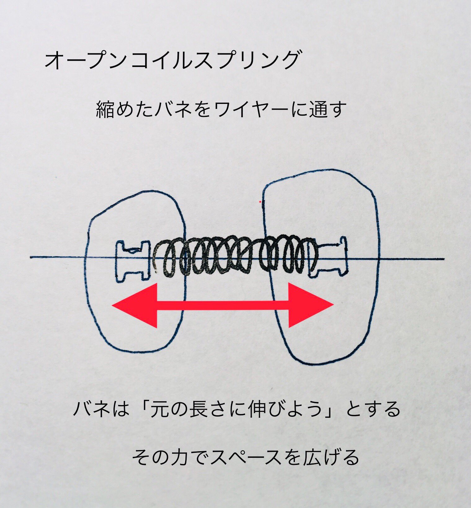 ふじか 歯列矯正済み オープンコイルスプリング 歯と歯の間隔を広げる 金属で ゴム系の素材よりも強力 省略してオープンコイルとも 通称バネ 長所と短所 歯を動かす力が強い 長期間パワーを保つ 目立つ 歯磨きしにくい 唇に当たる