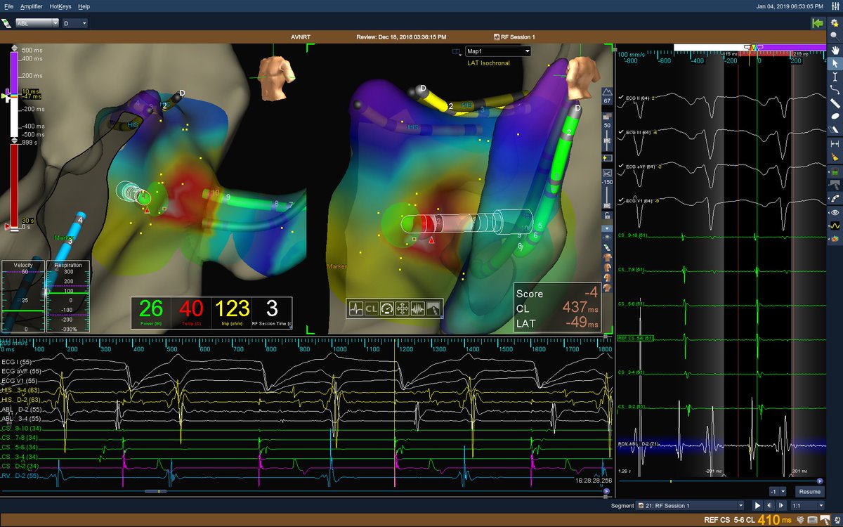 MicheleB_MD's tweet image. My personal Xmas present: 3 #accessorypathways in 2 days. Case nr. 3. #XRayFree Mapping (during oAVRT, long RP, CL 410msec) and Ablation (during A-pacing at similar CL, nice trick to achieve same location and avoid jump at termination. #SVT #oAVRT #epeeps #Cardiotwitter #EP_nerd