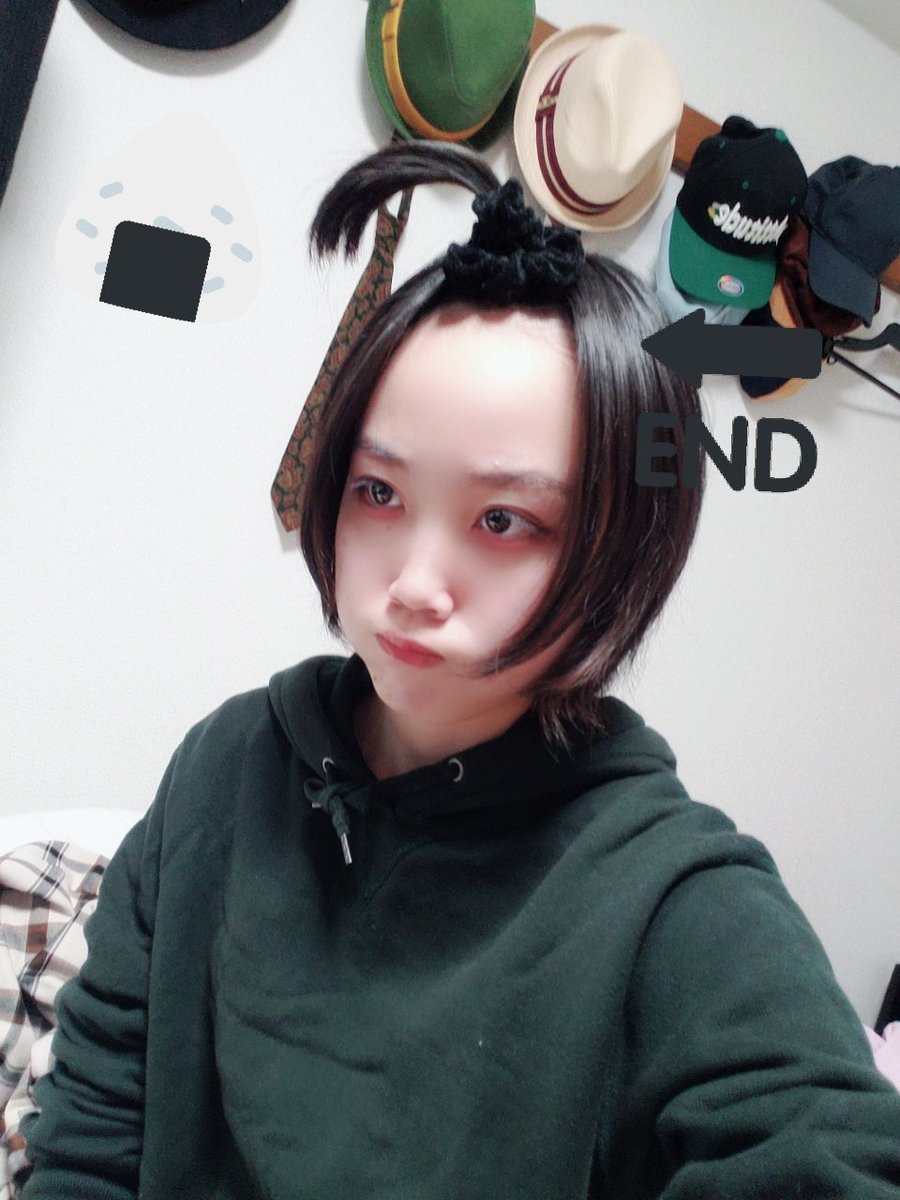 生え際の後退 生え際の後退
