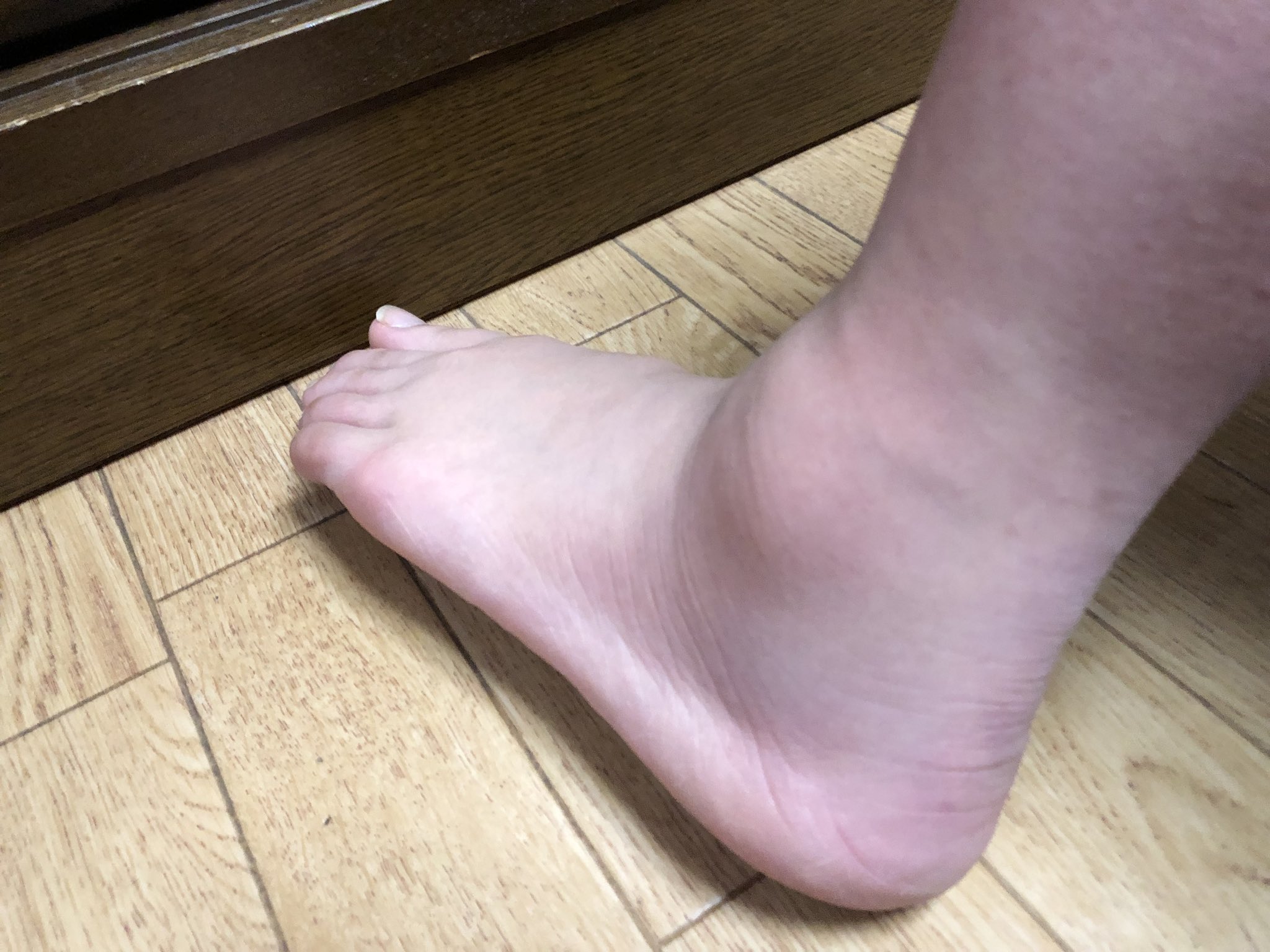 Twitter पर Yuki 骨折4日目 まだまだ晴れています パパの包帯の巻き方が昨日より上手 松葉杖は腕と背中の筋肉を使うね 明日からが本番 頑張るしかないっしょ٩ ๑ ᴗ ๑ ۶ Twitter पर Yuki 骨折4日目 まだまだ晴れています パパの包帯の巻き方が昨日より上手 松葉杖は腕と背中の筋肉を使うね 明日からが本番 頑張るしかないっしょ٩ ๑ ᴗ ๑ ۶