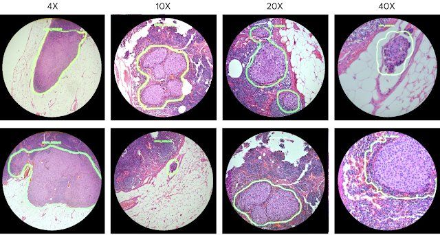 This microscope uses AI to detect life threatening diseases and points them out to the viewer in real-time using augmented reality. 
buff.ly/2EReMl6
#VR #VR180 #Photography #Lucidcam #Beatcancer #AI #AR