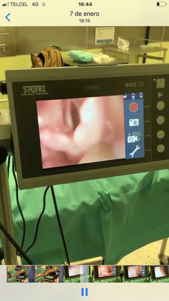 cuellarluis's tweet photo. Intubación retromolar con fibrobroncoscopio FIVE, técnica Dr Dam-Thuy Truong, por @ballantines84 Residente de Alta Especialidad Anestesia Oncológica @incanMX , producto de la rotación de nuestros residentes en @MDAndersonNews Gracias al apoyo y colaboración de @juanpcata https://t.co/MqMbiauVgj