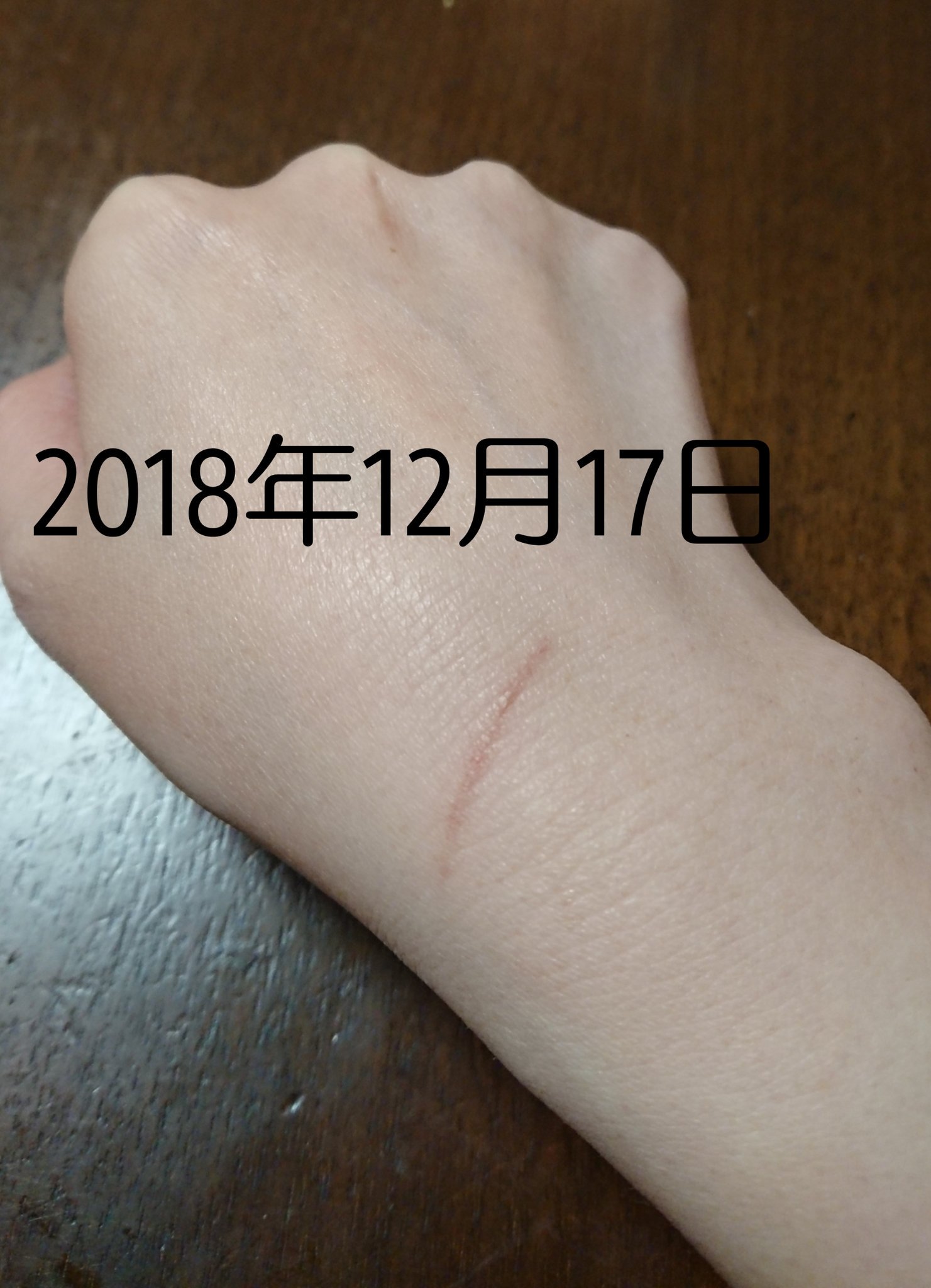 えみ姉 En Twitter 小林製薬のバイオイル 毎日傷跡に塗って 約1ヶ月 薄くなったきがする 小さい瓶のやつ買って まだまだある コスパも良いね 私は傷が残りやすいタイプ