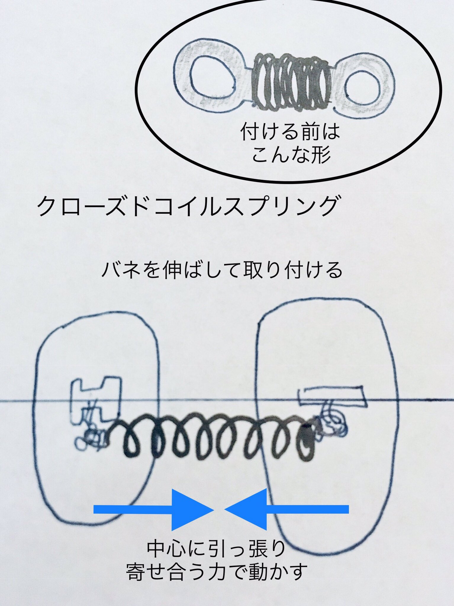 ふじか 歯列矯正済み クローズドコイルスプリング 歯と歯の隙間を閉じる 金属製でゴム系の素材よりも強力 通称閉じるバネ 長所と短所 歯を動かす力が強い 長期間パワーを保つ 目立つ 歯磨きしにくい 結構唇に当たる クローズ ド ドを