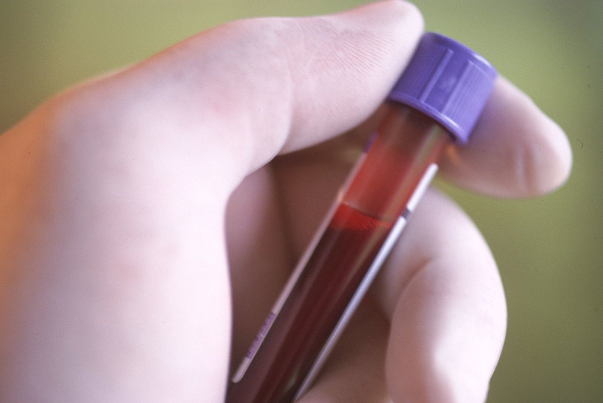CHU_Montpellier's tweet photo. #Recherche Notre équipe d'hématologie développe une nouvelle méthode (CAR-T) pour combattre le #cancer.
L'idée est de reprogrammer des #cellules afin de les rendre plus efficace contre les cellules #malignes.
Pour en savoir plus ➡️ https://t.co/9kPyfbYW6R https://t.co/4tXWjDeKDg