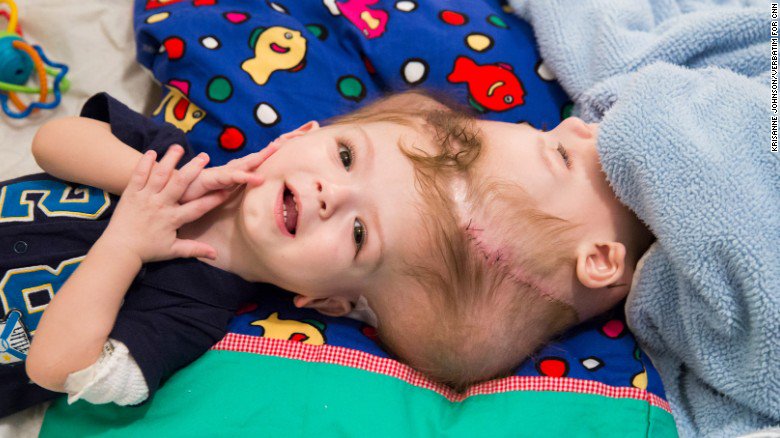 NurseGroups's tweet photo. For Parents Of Separated Twins, Inspiration And Heartache #conjoinedtwins #lifeapart #surgery https://t.co/plcgQ2RTSh https://t.co/lQKBZlY9f2