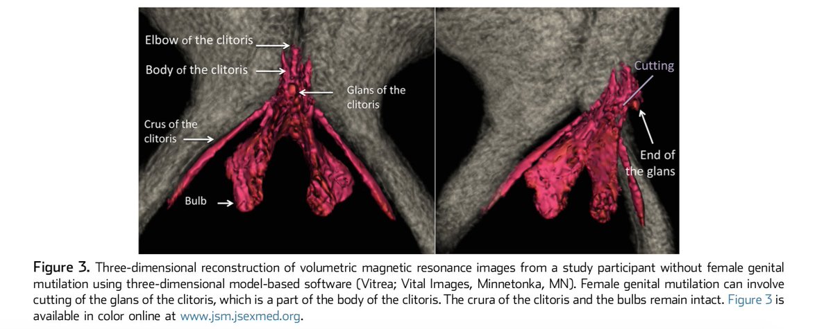 As my brilliant colleague Dr. Jasmine Abdulcadir shows in the below MRI, the most extreme forms of FGM affect the glans of the clitoris, leaving most of its erectile tissues & structures relevant for orgasm intact ( https://bit.ly/2QpBzdK ,  https://bit.ly/2Tqgfq2 ). Moreover,