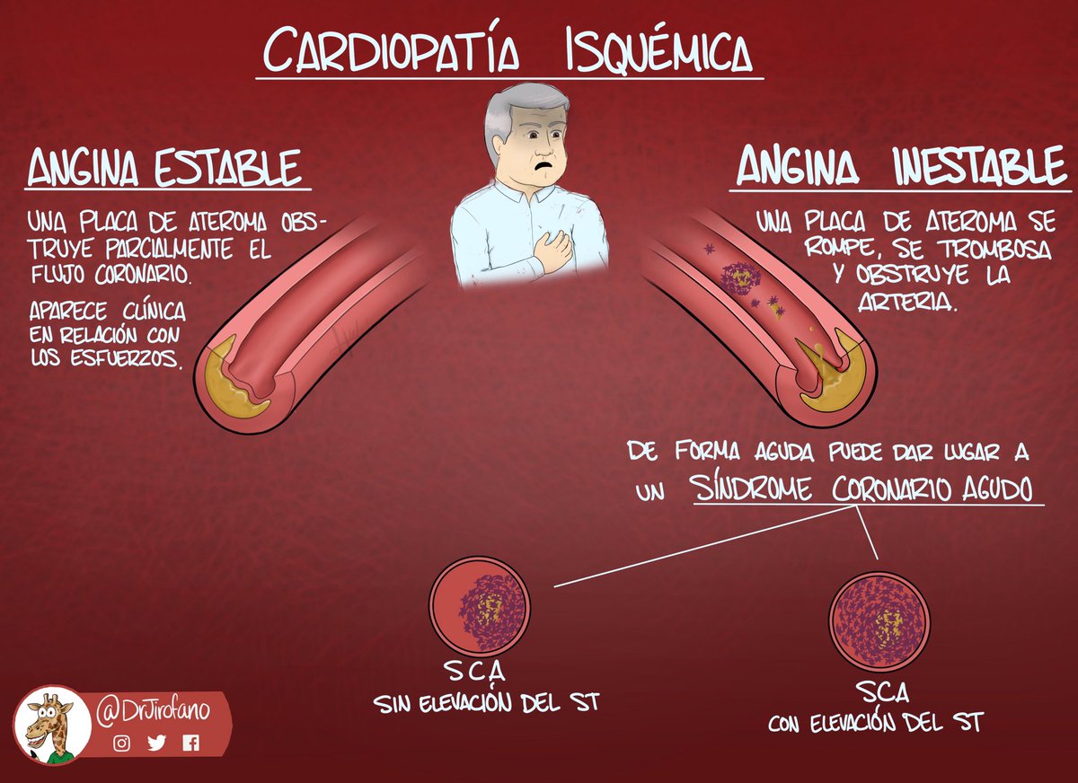 DrJirofano's tweet photo. Un esquema sencillo de la cardiopatía isquémica para empezar el año. La primera causa es la aterosclerosis, un breve resumen de cómo sucede.
Ya trabajando en hacer un algoritmo terapéutico muy visual👀

#medicinagrafica #2MIR19 #mir #SCA #cardiologia #chuletasmedicas https://t.co/EtVTncBKlh