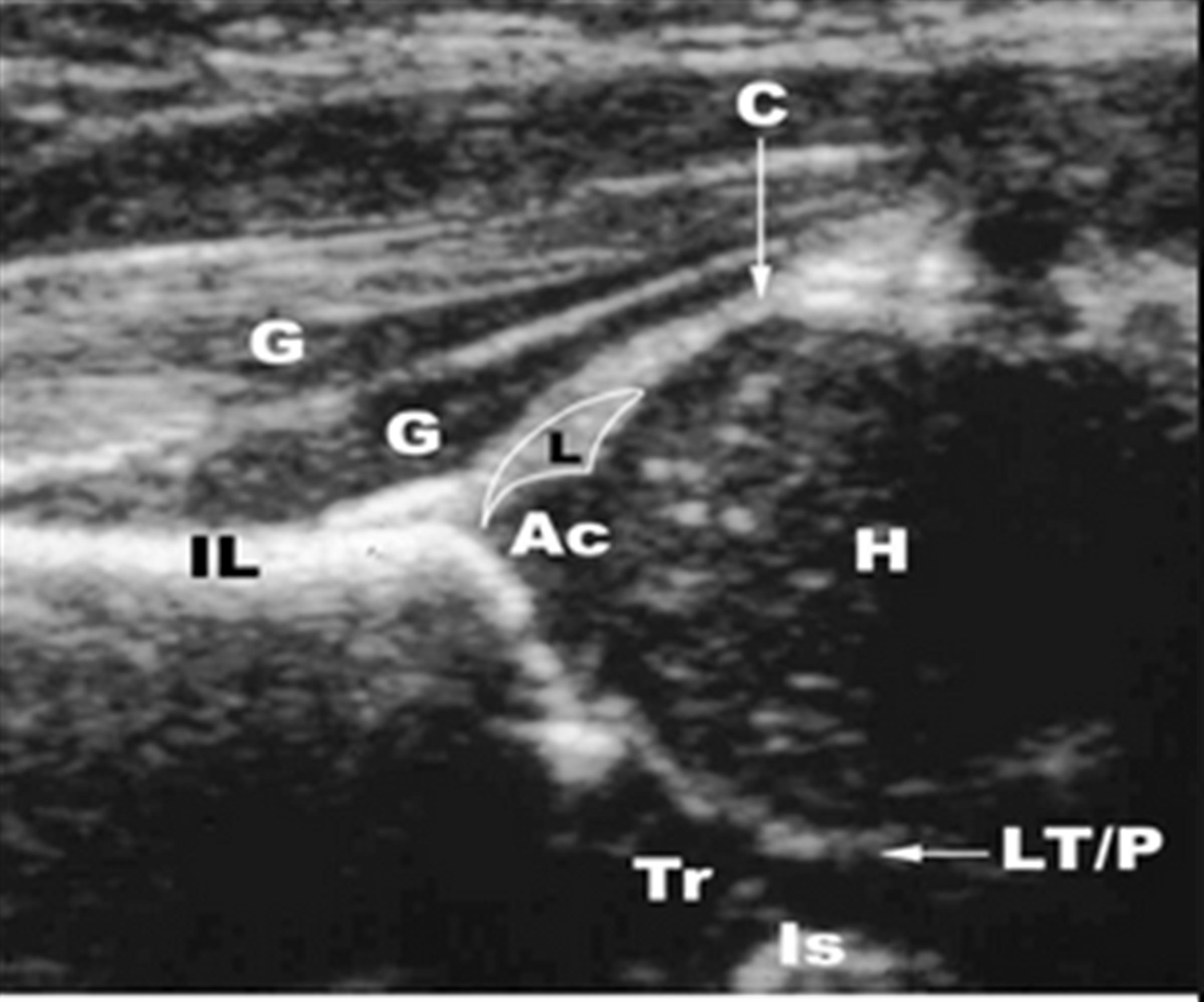 Orthobullets on Twitter "DDH treatment is dependent upon patient age