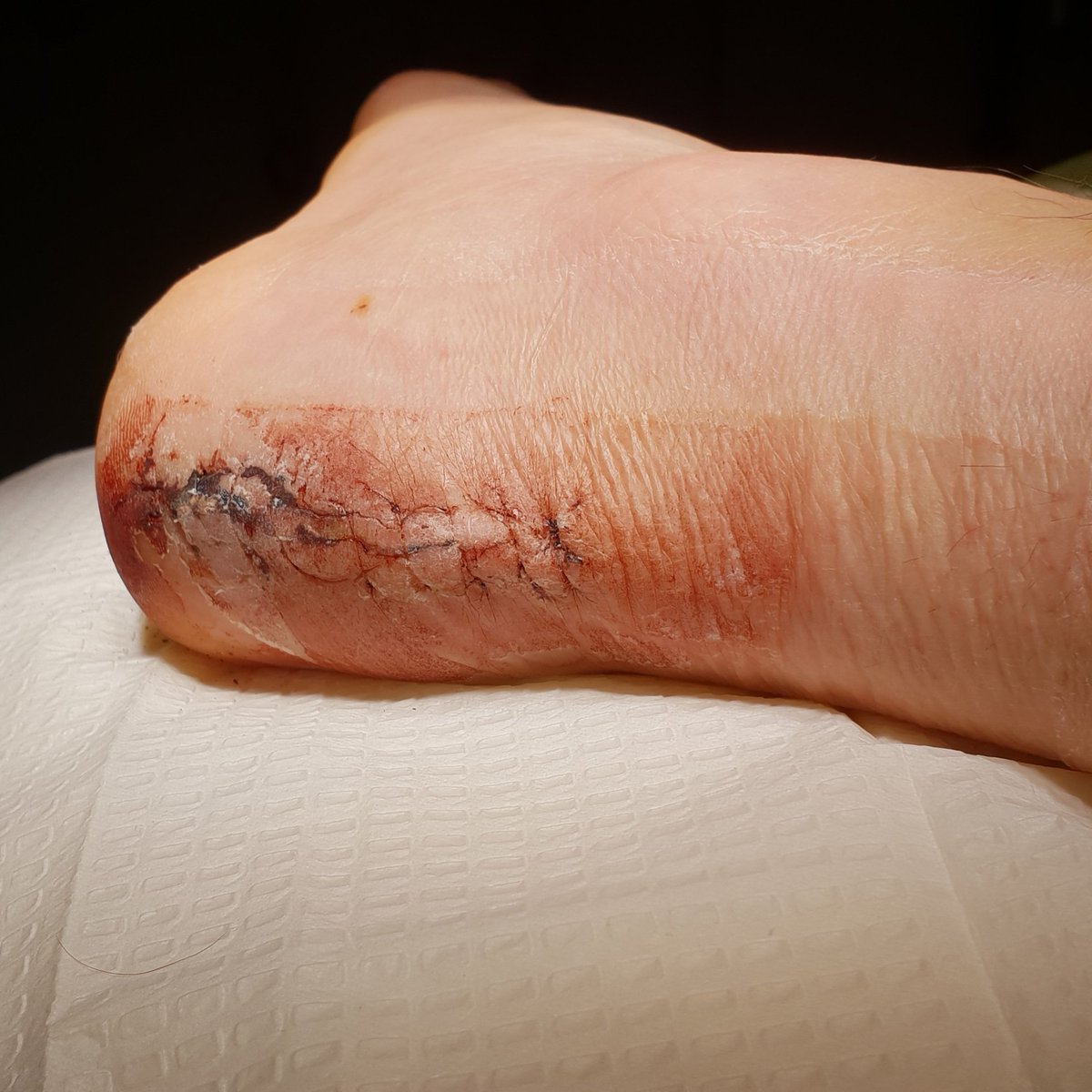 Mangled foot... the cast is off... the stitches are out... and i can scratch!! #recovery #freedom