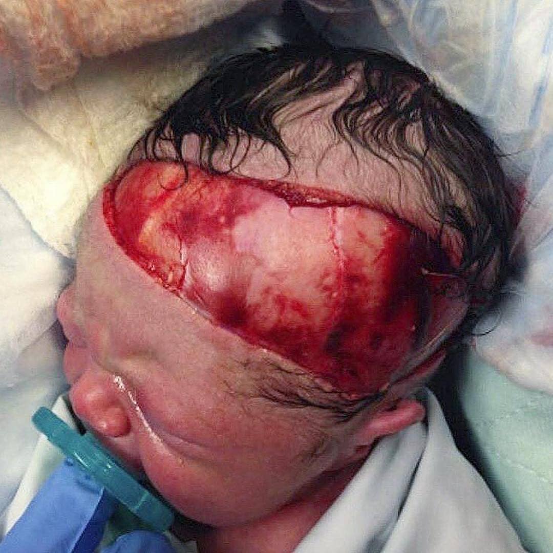 FMGEMCIEXAM's tweet photo. Complications in a caesarean section caused a severe laceration to a newborn.
.
.
.
.
.
#medicnerd #ems #firstresponders #firefighter#emt #paramedic #medic #nurse #emtschool#emtstudent #emsinstructor #paramedicschool#paramedicstudent #nursingschool #nursingstudent#medschool https://t.co/GxNLGAxkGG