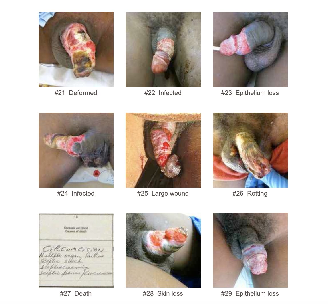 dozens of boys die each year from their initiation rites, with multiple penile amputations and hospitalizations ( https://bit.ly/2VtYoQV ). Extensive, gruesome photographic evidence is available at  http://ulwaluko.co.za/  - random sub-set below. Among the Xhosa,