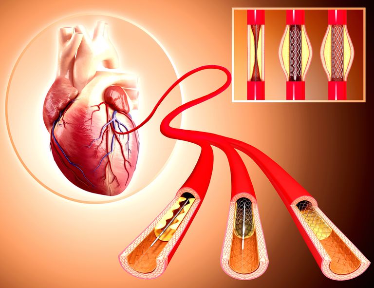 Article of the day #કોરોનરી એન્જીઓગ્રાફી - વિશ્લેષણ by #DrKamleshShah #CoronaryAngiography #heartattach #angioplasty #stent #block https://konecthealth.com/doctor/articles/HCNKStGUJFc …