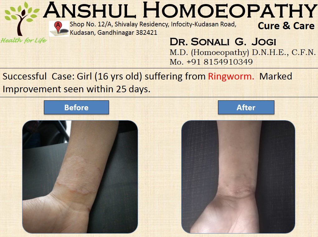homoeo_anshul's tweet photo. Successful case in Ringworm. Marked Improvement seen within 25 days. #ringworm #skindisease #AnshulHomoeopathy #MDHomoeopath #Gandhinagar #Ahmedabad #Homoeopathywonders #Homeopathy
Pls share it with your friends & family https://t.co/Hrw056IetO