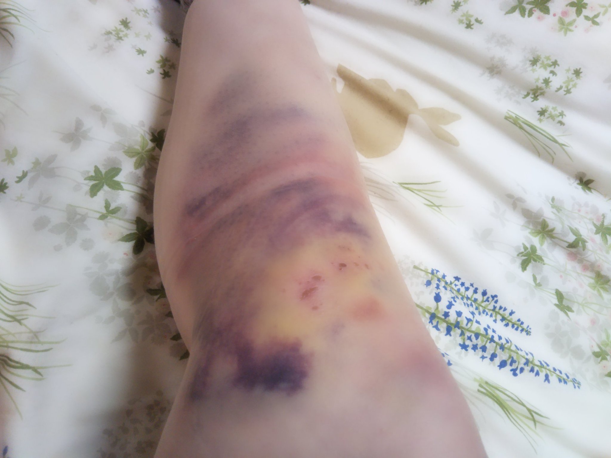 自転車 で 転倒 打撲