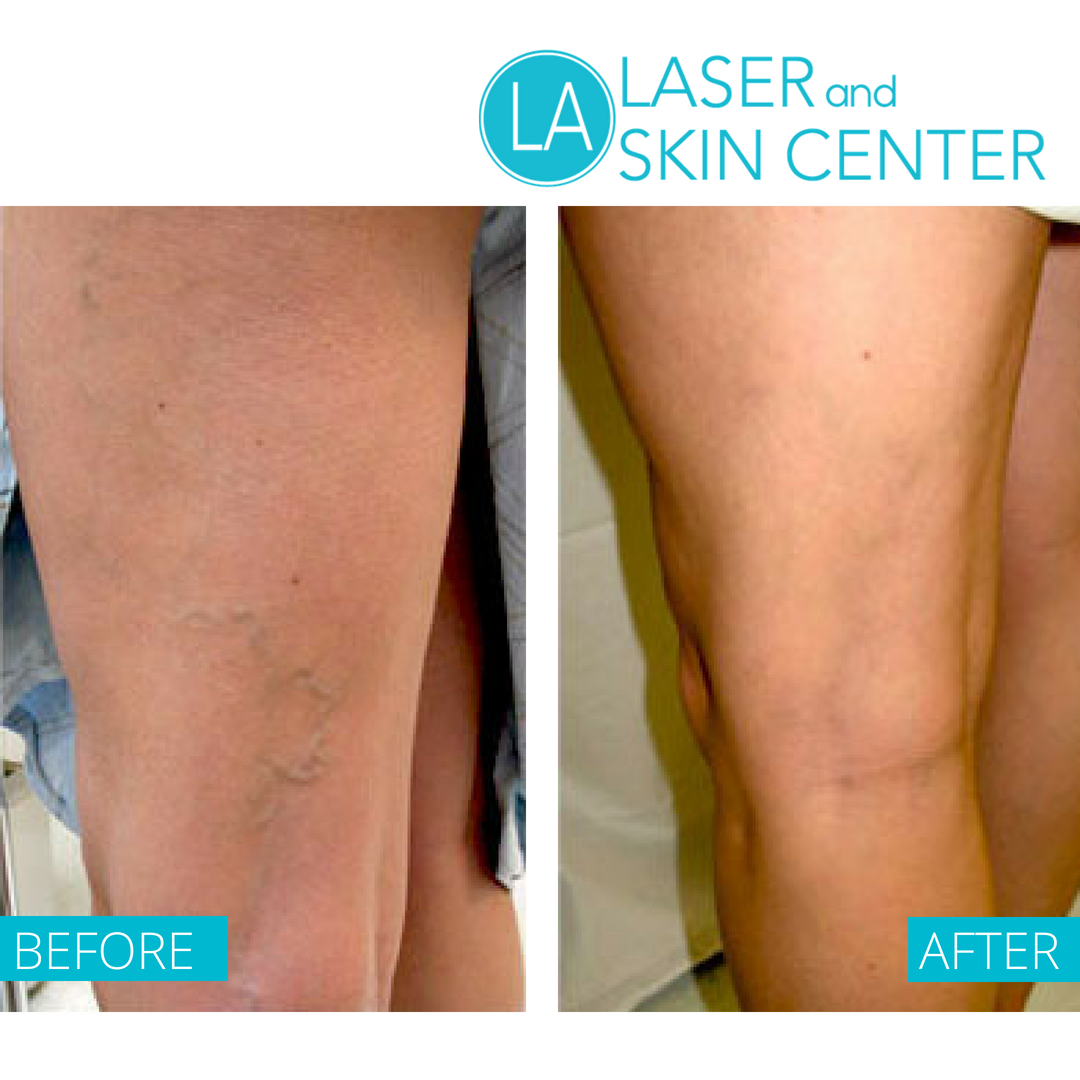 LALaserCenter's tweet photo. Get gorgeous &amp; smooth, varicose vein-free and spider vein-free legs with our exclusive Sclerotherapy. This minimally invasive procedure can rid yourself of those  gnarled, enlarged veins.
Learn more https://t.co/gOhZUrwhec and call (800) 501-DERM to schedule a consultation! https://t.co/bwGuGDB5KU