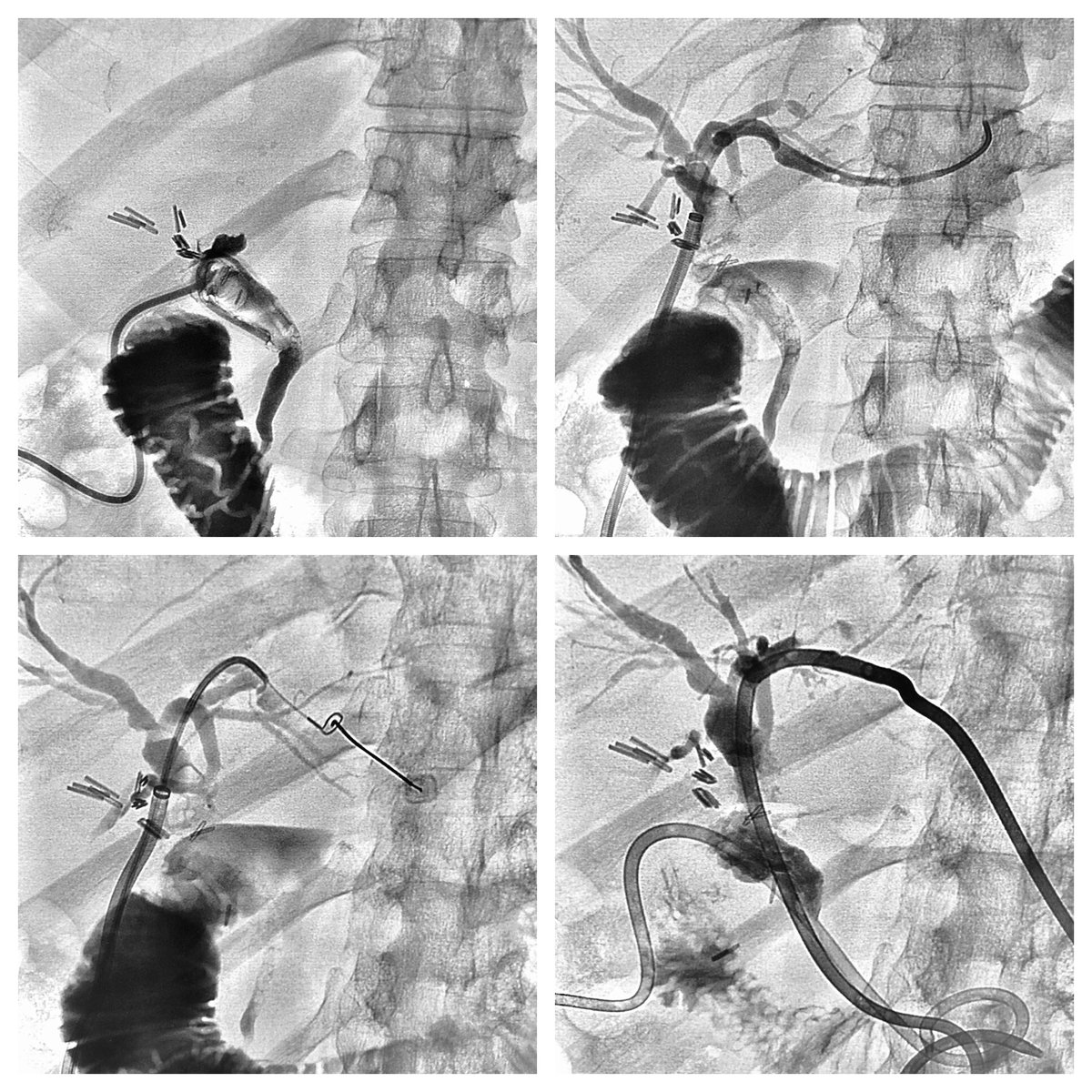 MTV_IR's tweet photo. 45 y/o F w/#retainedstones S/P #laparoscopiccholecystectomy. T-tube chged w/#CookCheckFloSheath & the L #biliarytree accessed w/#angledcatheter & #glidewire. 4mm #EV3loopsnare placed into L ductal system & #percutaneousaccess obtained. 10F #biliarydrain placed L & T-tube 4 drain https://t.co/ix1e5mkDkF