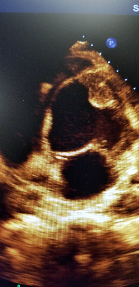 bawejamd's tweet photo. Largest LV thrombus ever seen?
#cardiotwitter #echofirst #accfit @ase360 @ShariqShamimMD @momermd https://t.co/pZZ0rT1e8Z
