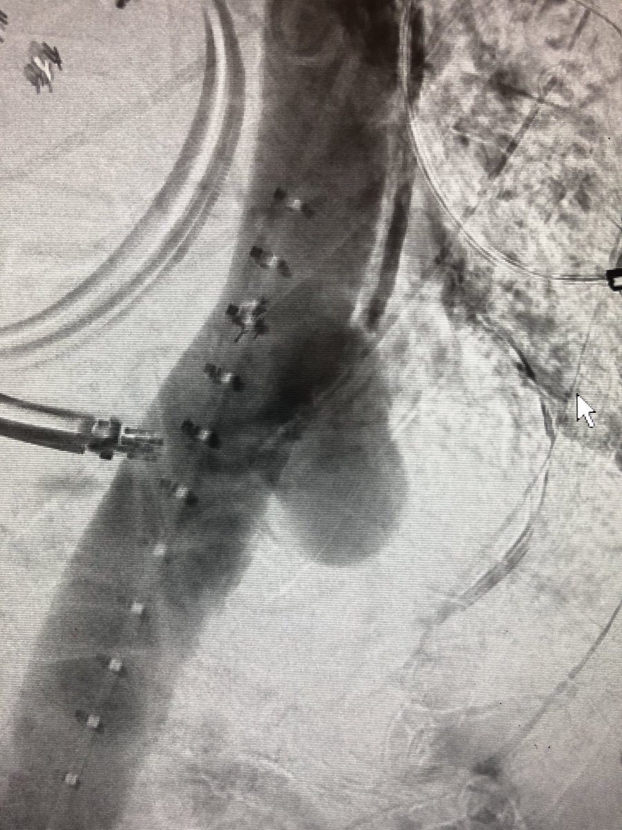 DrAliAzizzadeh's tweet photo. #TEVAR under #local #anesthesia for #symptomatic #saccular #descending #thoracic #aortic #aneurysm #DTAA #minimallyinvasive #vascularsurgery @CedarsSinai https://t.co/gbiye9iFSH