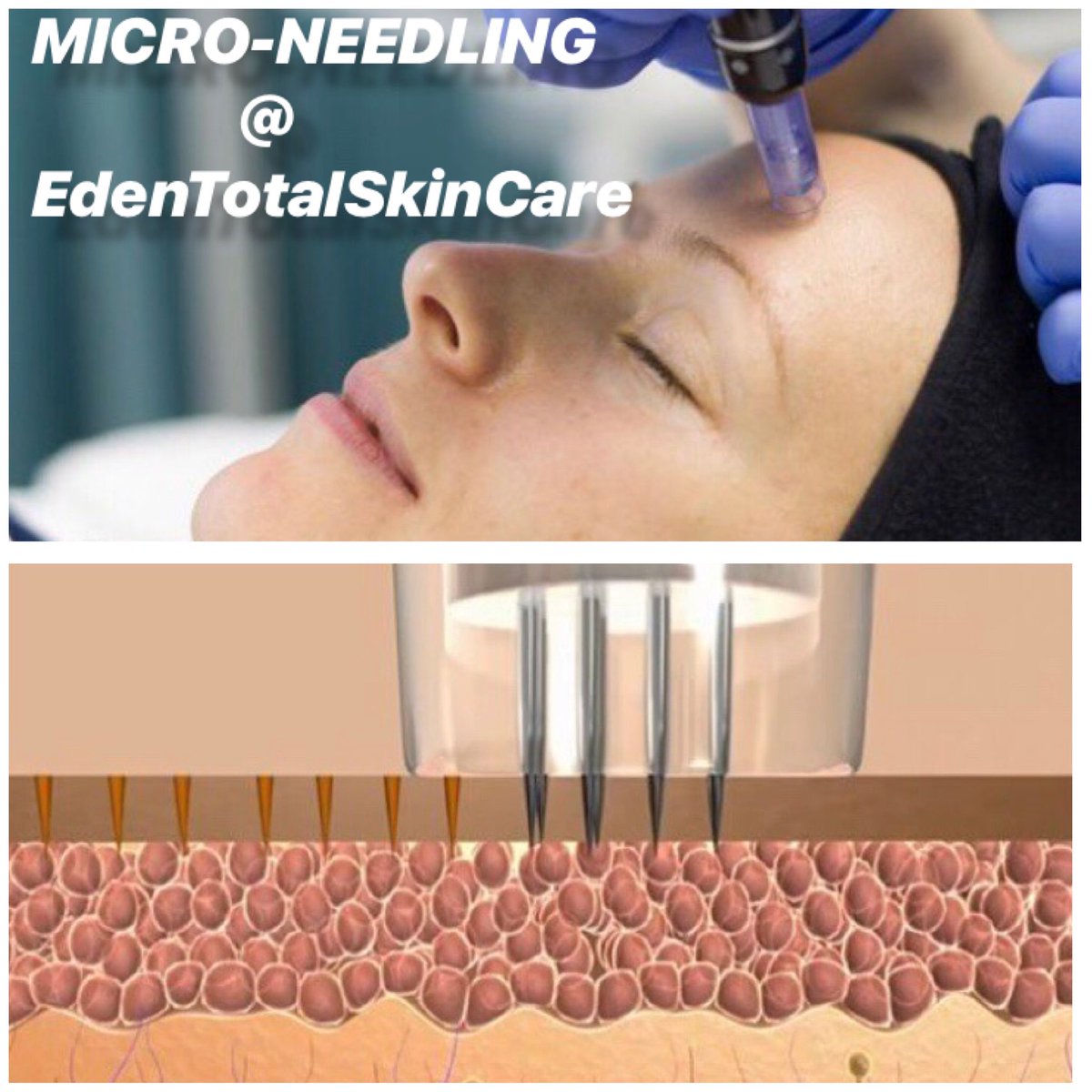 EdenTotalSkin's tweet photo. MICRONEEDLING is a minimally invasive cosmetic procedure that stimulates the production of Collagen &amp; Elastin. #Microneedling #spa #rockvillecentre https://t.co/E77Fc2Q47L
