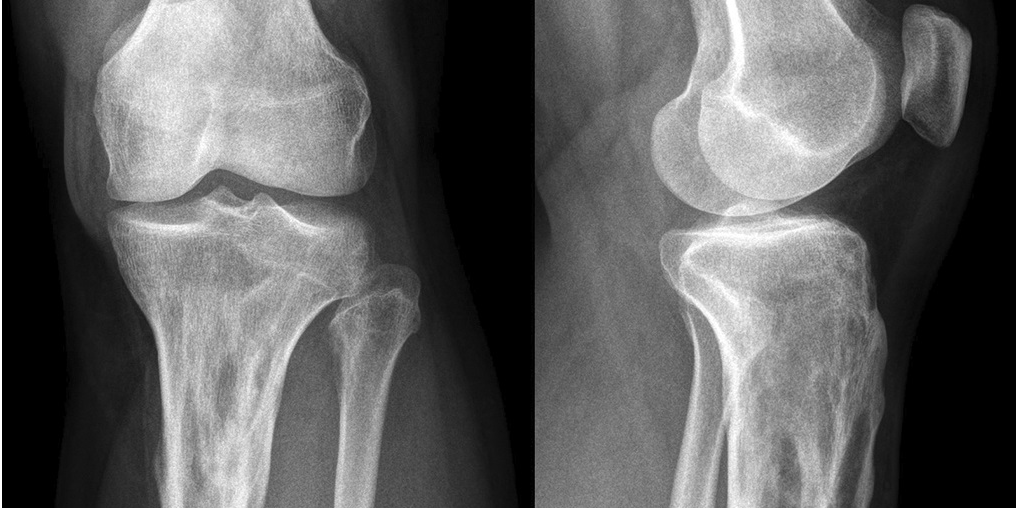 jbjs's tweet photo. Test your knowledge with the #JBJSImageQuiz: A 37-Year-Old Man with Continuing Left Knee Pain - https://t.co/Z1mHms1rtB What is the diagnosis? https://t.co/HKk8IJHkT2