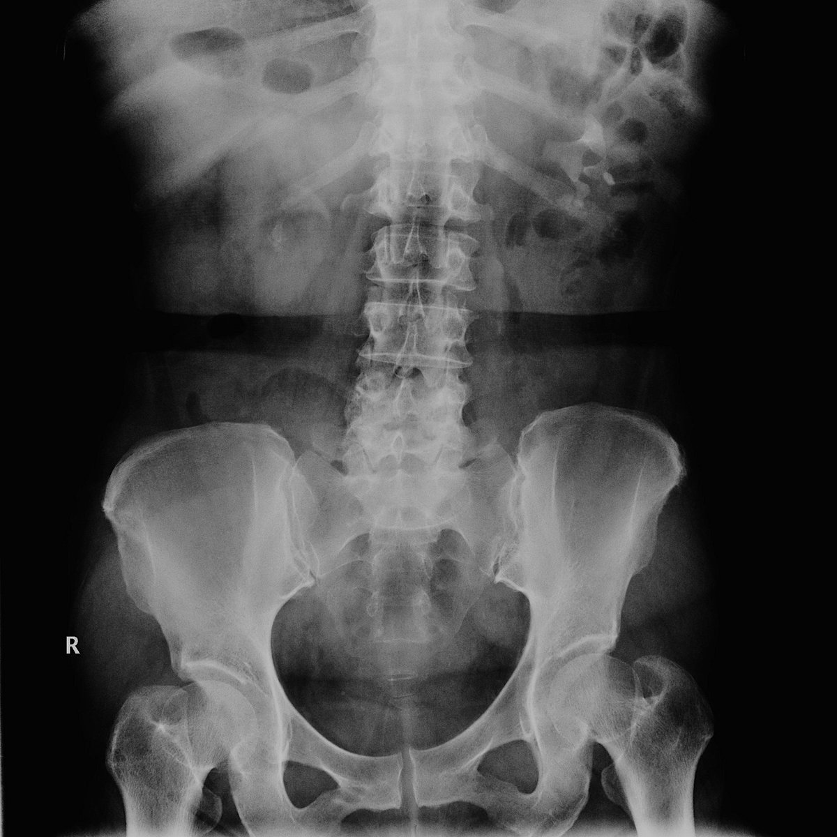 jteoh_hk's tweet image. #Case2 #UroSoMe #LiveCaseDiscussions
A 45 year-old woman presented to you with bilateral loin discomfort for a few months. Renal function is normal. This is the KUB and IVU. How to proceed further?
