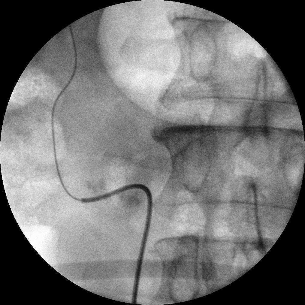 jteoh_hk's tweet image. #Case5 #UroSoMe #LiveCaseDiscussions
A 50 year-old man presented to you with bilateral loin pain. Simultaneous bilateral URSL was arranged. Started with right side, difficulty was encountered. How would you proceed further?