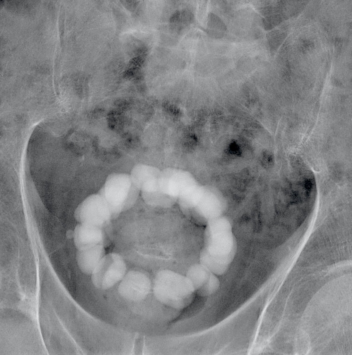 jteoh_hk's tweet image. #Case7 #UroSoMe #LiveCaseDiscussions
A 75 year-old man presented to you with lower urinary tract symptoms. DRE: Big prostate. This is the X-ray.  How would you manage the patient?