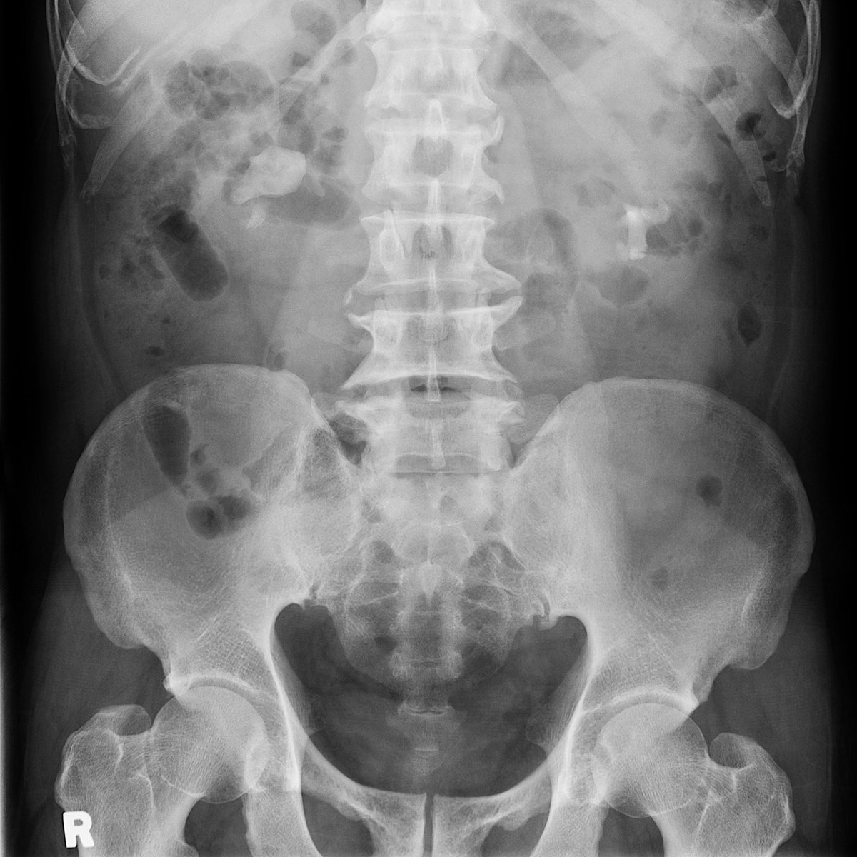 jteoh_hk's tweet image. #Case8 #UroSoMe #LiveCaseDiscussions
A 60 year-old woman presented to you with non-specific back pain. This is the KUB and IVU. Any suggestions what to do next?