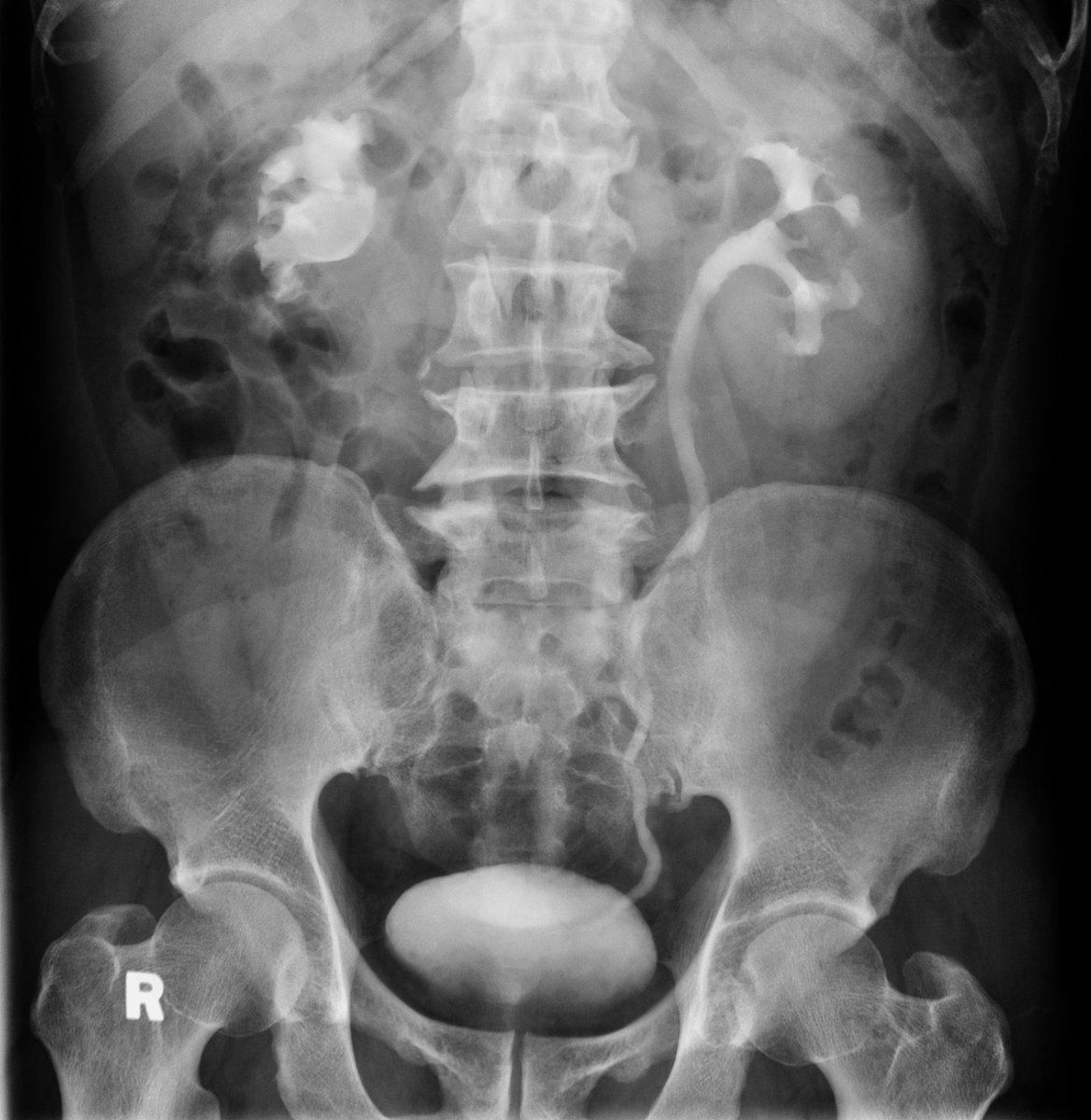 jteoh_hk's tweet image. #Case8 #UroSoMe #LiveCaseDiscussions
A 60 year-old woman presented to you with non-specific back pain. This is the KUB and IVU. Any suggestions what to do next?