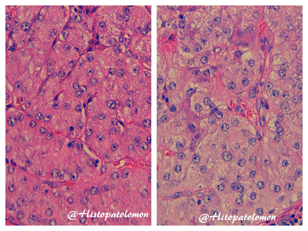 Histopatolomon's tweet photo. 60 y/o. Tumor polipoide en fundus gástrico. 
Clinical past: Renal cell carcinoma 10 years ago.
#pathology #GIpath #NeverSeenForme What do you see? 
#pathologists #histopathology #patologia #patologo
@DraEosina @CArnold_GI @InsdeTorres2 @steland011 @RaulSGonzalezMD @DraSabin https://t.co/hh96GUk02f