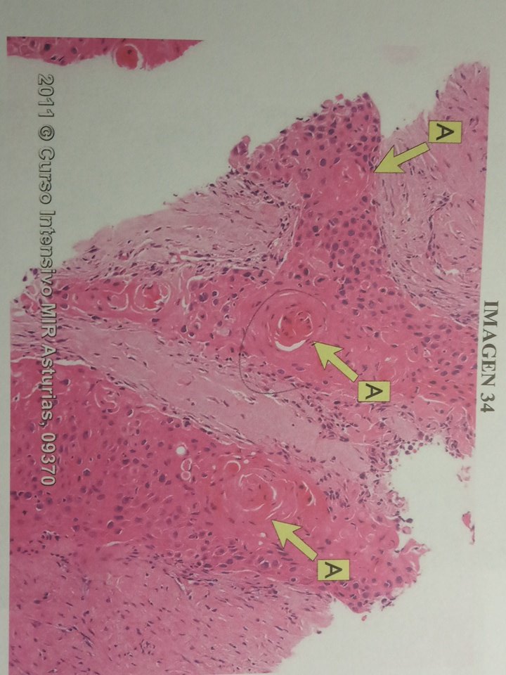 Silviavifores's tweet photo. Mientras tanto en el ministerio de Sanidad...
- No sé Rick, Carcinoma epidermoide? Parece un concepto RepeMir...
+ Voy a ligar la imagen a una imagen de Anatomía Patológica
😈
#Simu20 @mirasturias https://t.co/xv2wErU0uk
