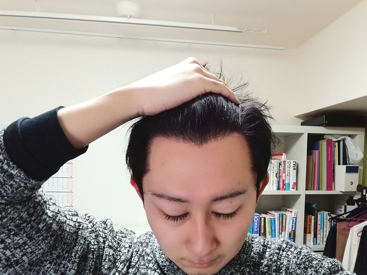 ハゲリーマンちゃんねる 毛髪診断士 ハゲ対策系youtuber 18年5月 中国でm字部分に植毛して来ました 8ヶ月経過現在の生え際です セット時も自然な仕上がり 経過観察 8ヶ月 スタイリング セット Aga Aga対策 自毛植毛 植毛 ハゲ M字ハゲ ハゲリーマンちゃんねる 毛髪診断士 ハゲ対策系youtuber 18年5月 中国でm字部分に植毛して来ました 8ヶ月経過現在の生え際です セット時も自然な仕上がり 経過観察 8ヶ月 スタイリング セット Aga Aga対策 自毛植毛 植毛 ハゲ M字ハゲ