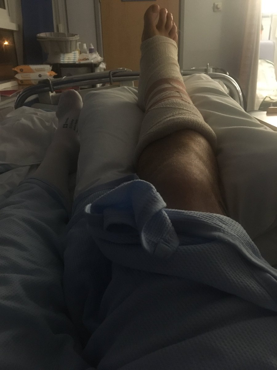mattholdy25's tweet photo. Op complete, full cast tomorrow and hopefully then home. #onelegwarrior https://t.co/YIfyrY8iYB