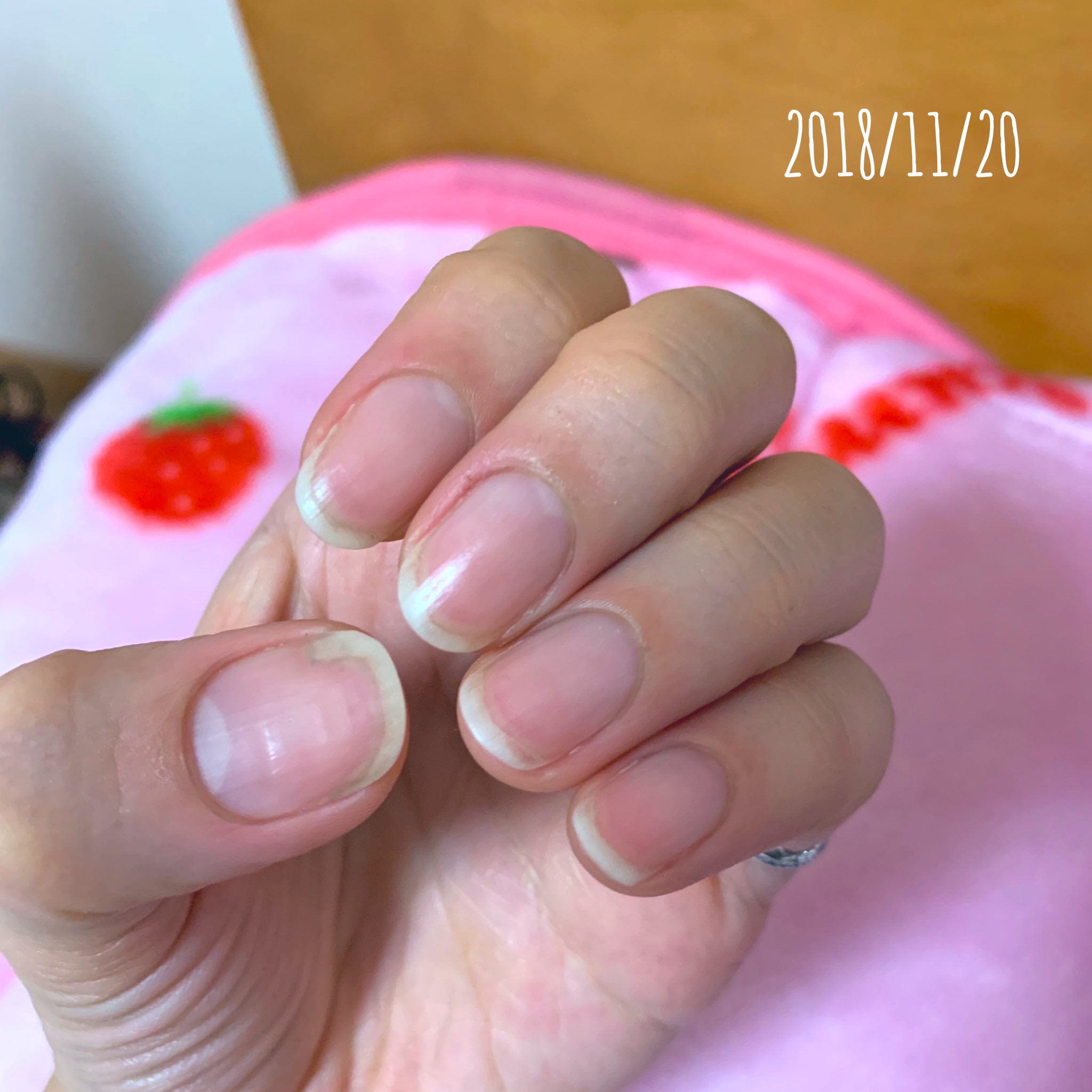 ゆう 育爪 剥離 Xxxl0l 2 Twitter