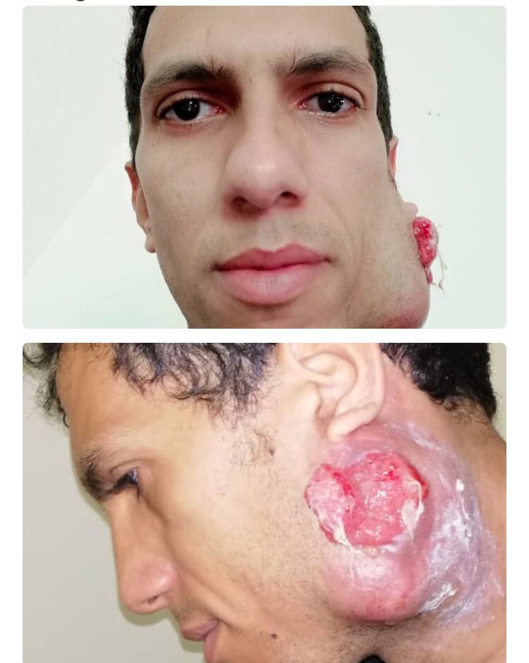 Servicio público. Él es ⁦<a href="/KuikasR/">Kuikas Rosales</a>⁩ comediante, artista y relacionista público. Necesita operarse de cáncer en el cuello y necesita tu apoyo gf.me/u/ptvq8f