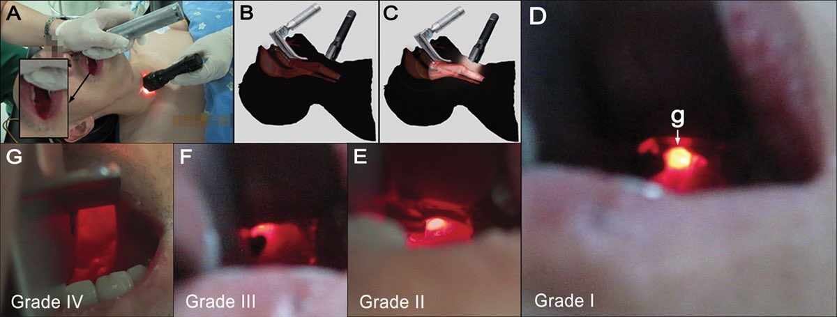NaveenEipe's tweet image. Or hold the flashlight against the anterior tracheal wall skin?
#transillumination
HT
Anesthesiology 2013, Vol.118, 1059-1064. 
Image-
anesthesiology.pubs.asahq.org/data/journals/…