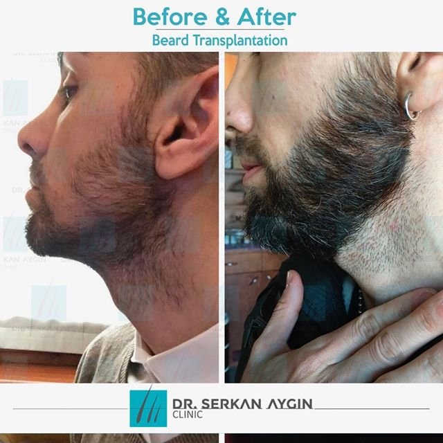 What to expect from a beard transplant operation? In 12 months you can get #backtobeard like our patient! #beforeandafter #beardbeforeandafter  #DHI #hairtransplantclinic #baldnesssolution #زراعة_اللحية #تكثيف_شعر_اللحية #زراعة_الشعر_في_تركيا #استرجع_شعرك