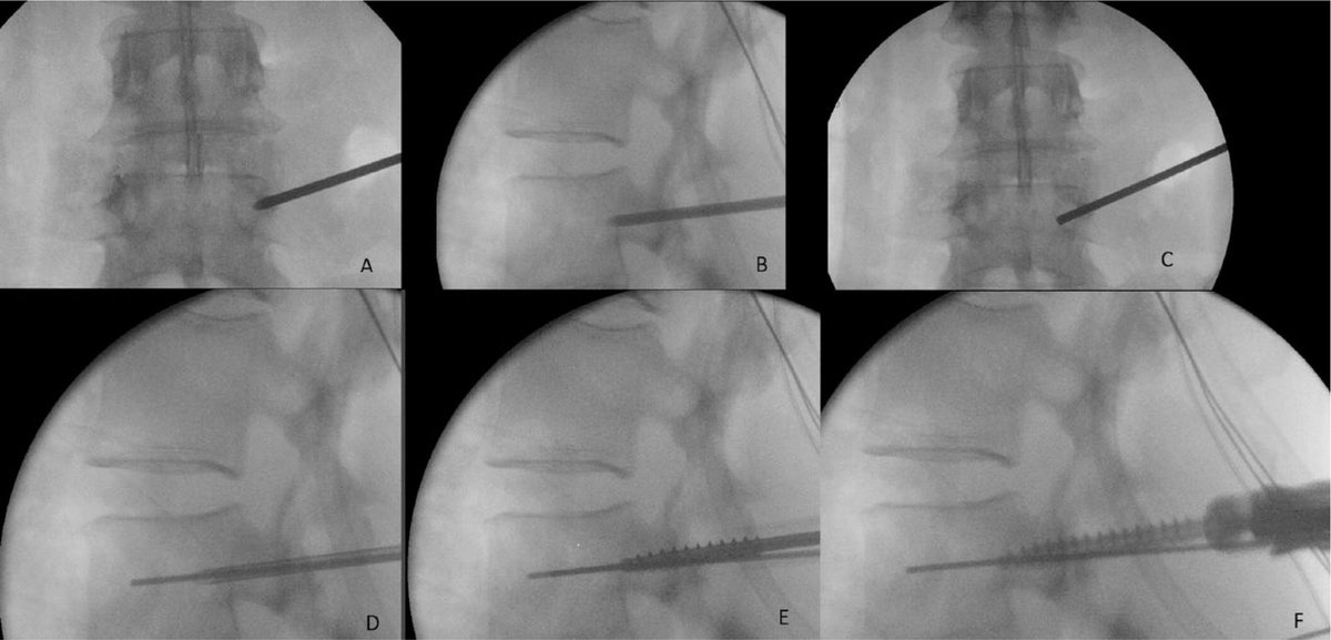 EFORTnet's tweet photo. Percutaneous fixation of thoracolumbar vertebral #fractures https://t.co/CNb9uhD76d pedicle targeting tech./ advantages & limitations/ controversies surrounding this method. #OpenReviews #surgery #spine #POPM #changepain #painmanagement #orthopaedics #surgery #trauma @BoneJoint https://t.co/4kF4HeCtf4