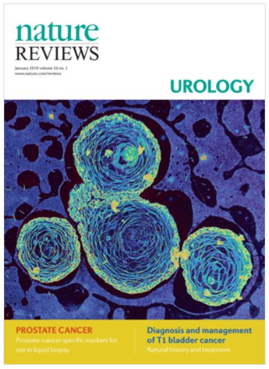 NatRevUrol's tweet photo. Our first issue of 2019 is live, with our beautiful new cover image from Hatem Sabaawy @celvive at @RutgersU Cancer Institute. It shows immunocytochemistry of prostate cancer patient-derived organoids (PDOs)  from FFPE sections in 3D matrix. https://t.co/X9RP5XLRHF