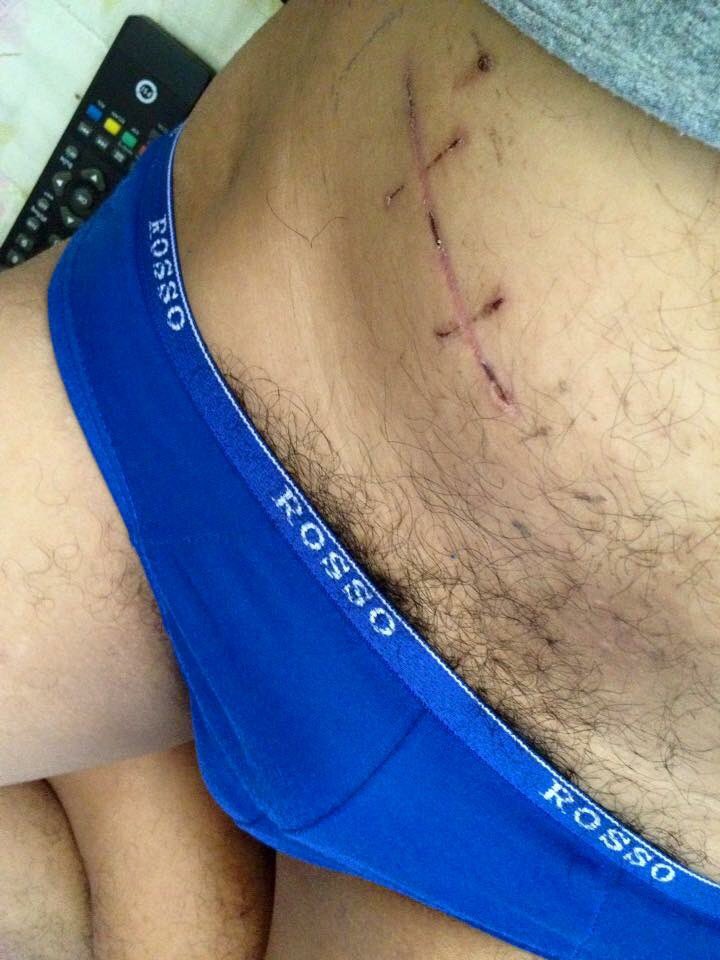 4 ปีแล้ว ทิ้งไว้แต่รอยแผลเป็น 😅