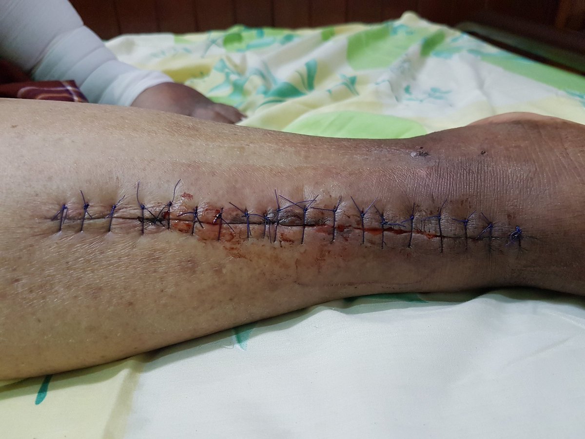 PMK_MALAYSIA's tweet photo. Dah 9 hari operation pun masih berdarah? Ni kene doktor tengok ni. Alhamdulillah PMK Homedicare ada doktor, nurse, MA, Fisioterapist dan lain2 yg bekerja dalam satu team. Senang pesakit kita. Tak perlu ke hospital atau cari doktor utk dtg ke rumah. #teamPMK #homedicare #pmkHRT https://t.co/qXpsMdKOqD