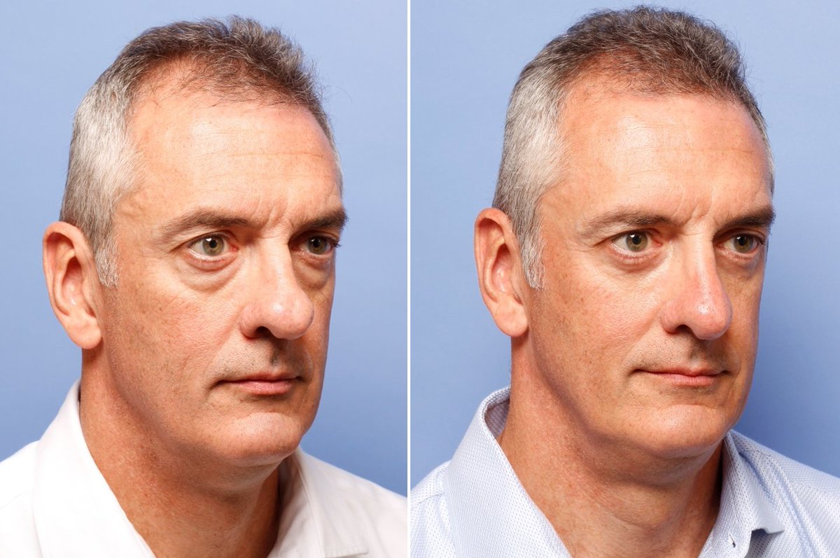 docromo's tweet image. ..Look at his amazing results! Join us at Romo Plastic Surgery’s website to witness the superior work and academic mind of Thomas Romo III M.D. 
romoplasticsurgery.com/procedures

#EyeLids
#AmazingResults 
#TimeandGravity
#RomoPlasticSurgery 
#DrRomo
#FaceLift
#PlasticSurgery
#LookYounger