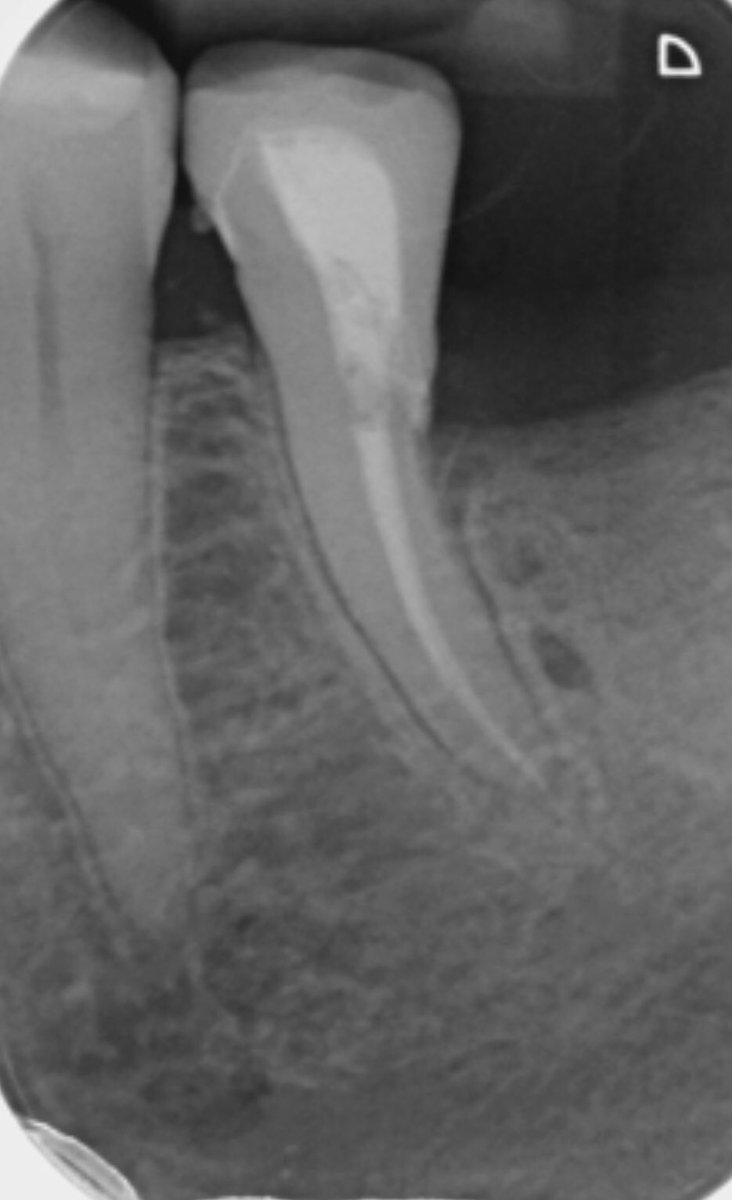 rootcanaluk's tweet photo. Let’s try give this tooth a chance!! #hemisection #endodontics #rootcanalclinic  #molar #rootcanal https://t.co/O3h3r13zVn
