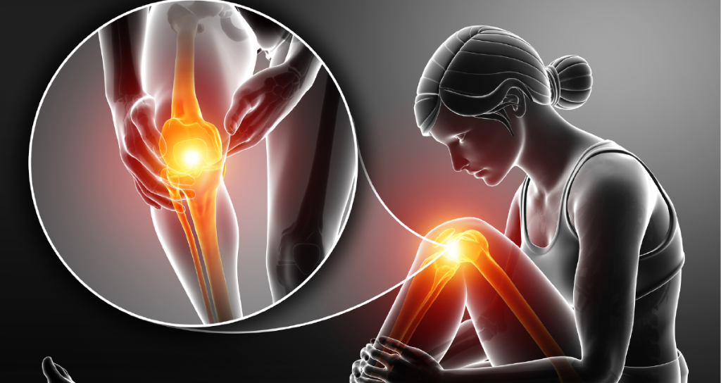 Las mujeres posmenopáusicas que tomaban terapia hormonal eran significativamente menos propensas a desarrollar OA de rodilla sintomática.