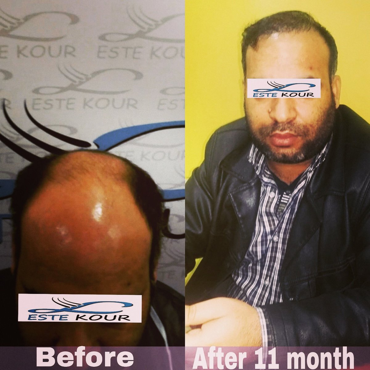 #مركز_إستاكور #هير #الأول #لزراعة #الشعر_في_تركيا #باسطنبول #إزمير #زراعة #الشعر #وجراحات #التجميلية
#زراعة_الشعر #زراعة #اللحية
#تجميل #الأنف #شفط #الدهون#تجميل وشد الوجه
Estekour Hair transplant istanbul Türkiye
للتواصل والحجز : 00905383857544
http://Www.estekour.com